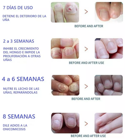 Parches Antihongos para Uñas – PackX3 Cajas